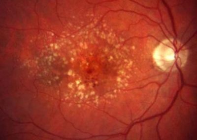 Degeneração macular relacionada à idade DMRI Dra Carolina Brandão